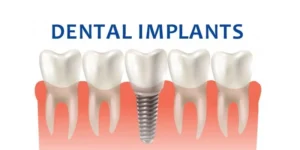 Read more about the article New Teeth in Just 2 Days: A Guide To Immediate Loading Strategic Implants
