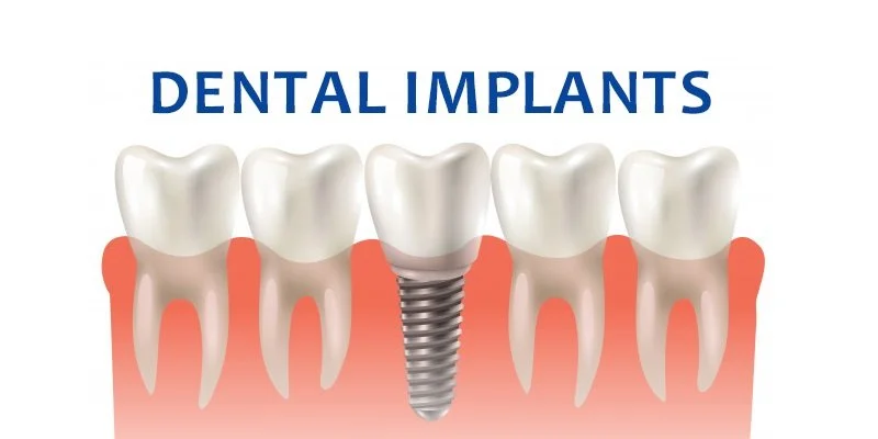 You are currently viewing New Teeth in Just 2 Days: A Guide To Immediate Loading Strategic Implants