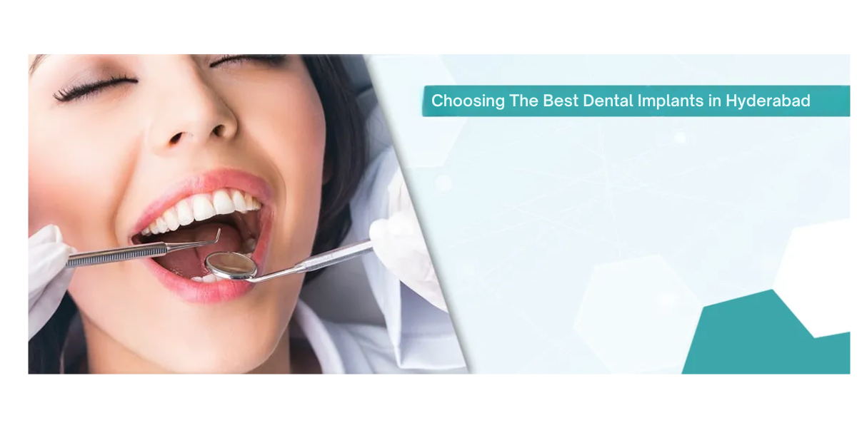 Why Quality Matters: Choosing The Best Dental Implants in Hyderabad For A Lasting Smile