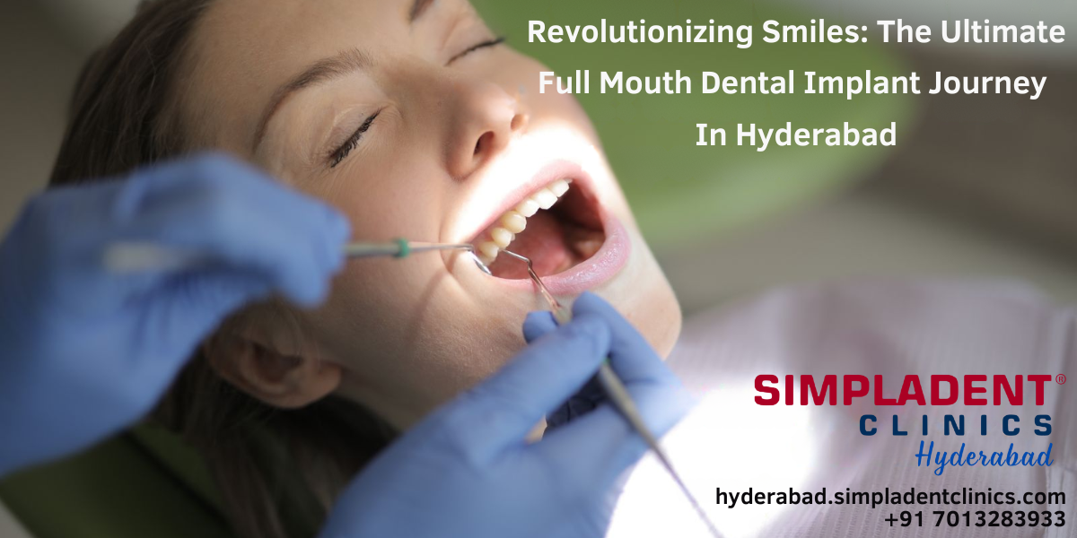 Revolutionizing Smiles: The Ultimate Full Mouth Dental Implant Journey In Hyderabad