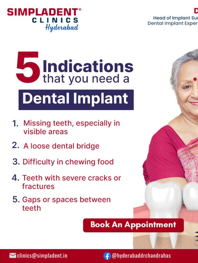 5 Clear Signs You Need a Dental Implant for a Perfect Smile