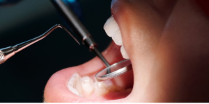 Read more about the article Do You Need Special Cleaning Tools For Dental Implants? Dr. Chandrahas Bathini Explains