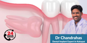 Read more about the article Unlock Your Perfect Smile With The Best Dental Implant Surgeon In Hyderabad – Dr. Chandrahas