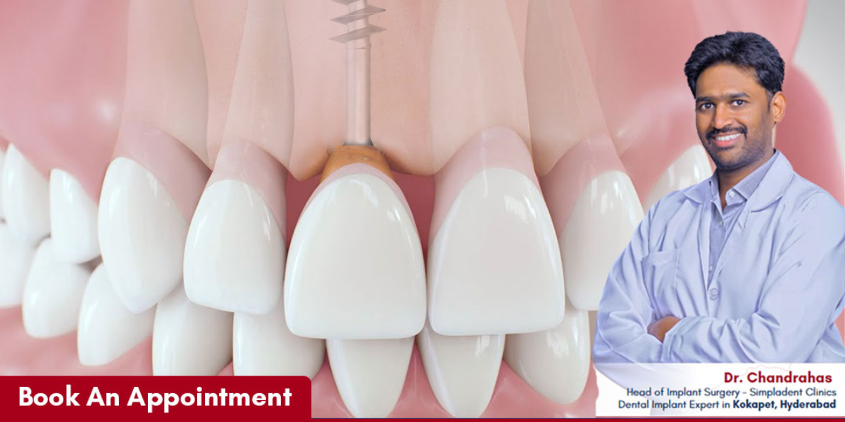 Expert dental implant surgeon, best implant dentist near me, full mouth dental implants, advanced implantology specialist, permanent teeth replacement solution
