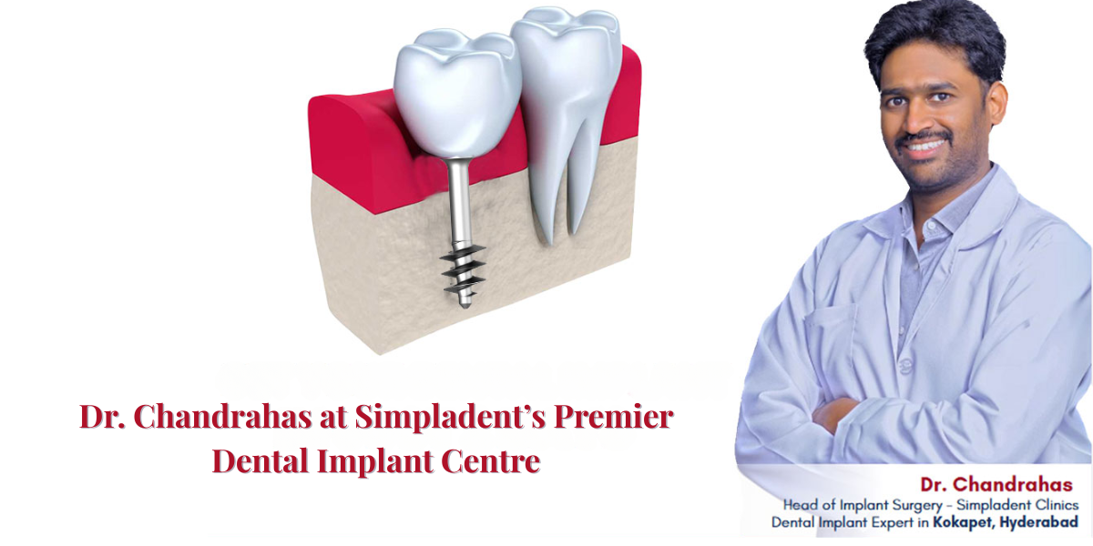 Permanent dental implants, best dental implant specialist, missing teeth solution, fixed teeth in 2 days, affordable dental implants in India